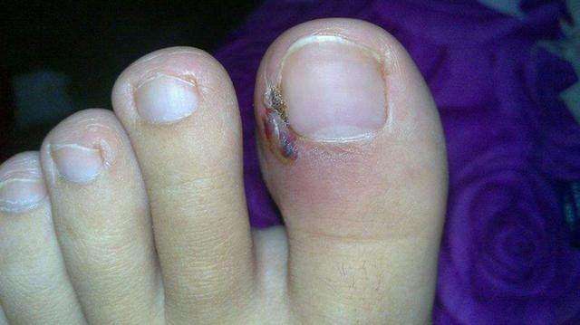 脚趾甲甲沟炎如何自己处理,甲沟炎指甲残留到肉里红肿怎么办