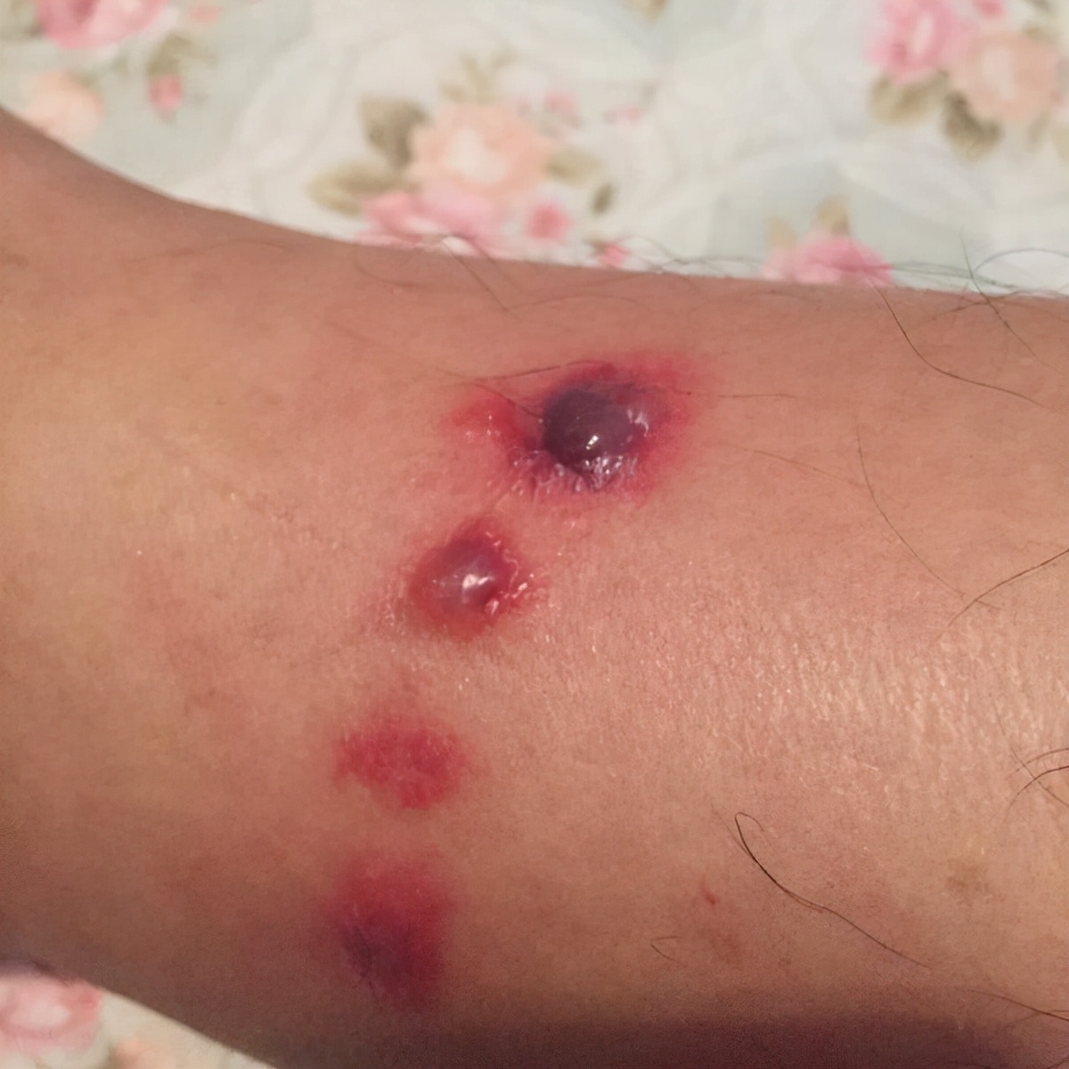 夏季虫咬皮炎怎么解决,夏季皮肤病攻略虫咬感染篇