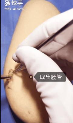 香蕉割包皮,洋葱剖腹产?这是我见过最秀的医生