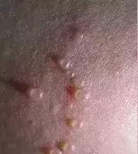 接触水痘的易感儿隔离观察多少天,孩子长水痘需隔离处理预防有三招