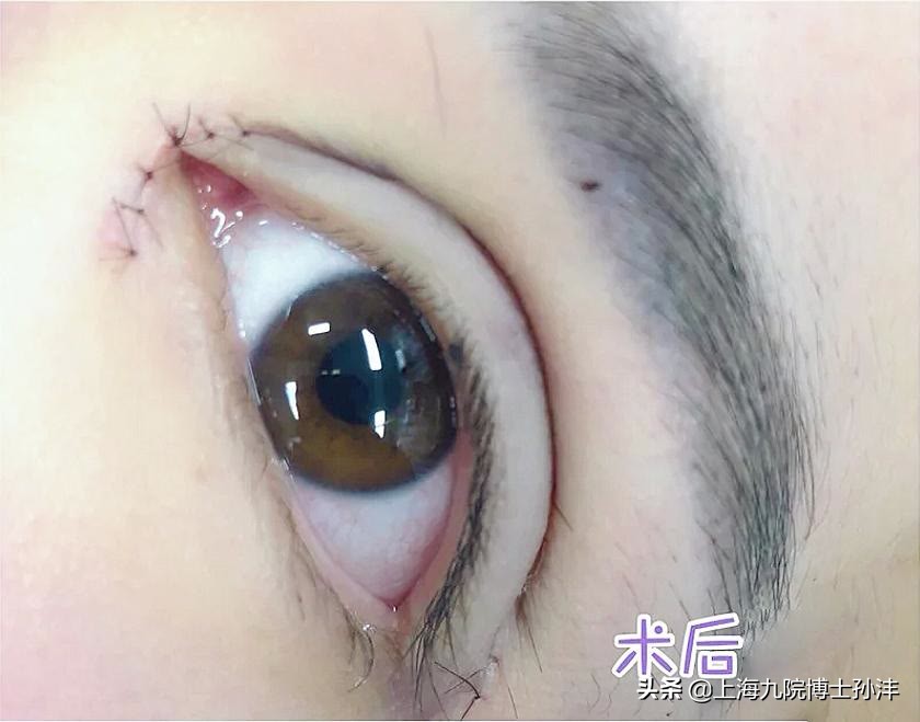 上海九院孙沣博士眼角修复,上海九院美容科孙沣