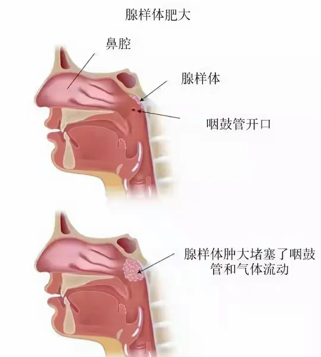 腺样体面容一定丑吗,腺样体面容患者16岁还会变丑吗