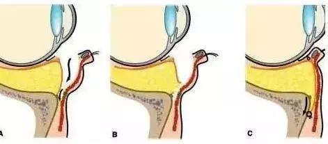 去眼袋15年后有细纹怎么办,祛眼袋之后会不会看着很平