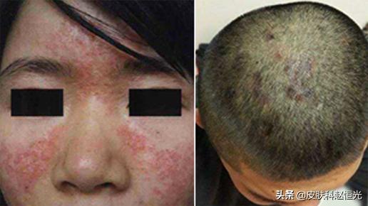 脂溢性皮炎总是反复,能治好吗?医生说其实能治愈