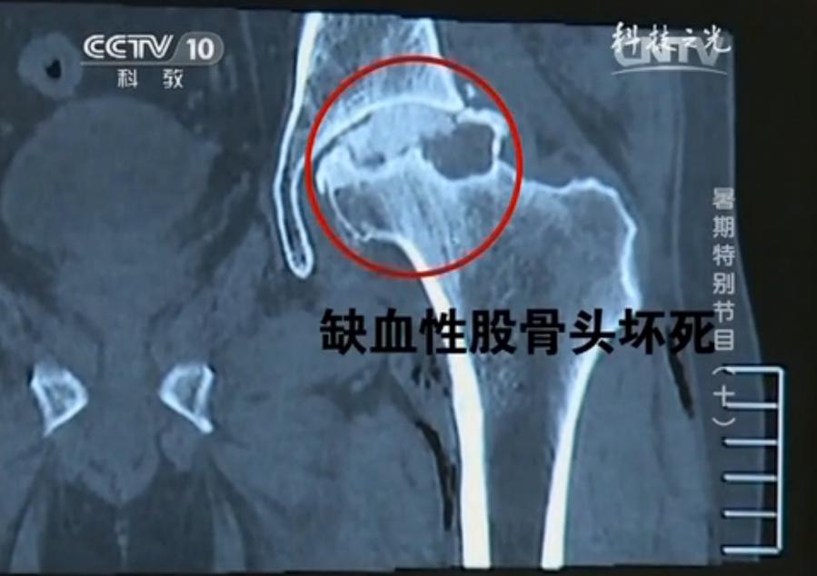 股骨头坏死讲解,股骨头坏死30秒自测