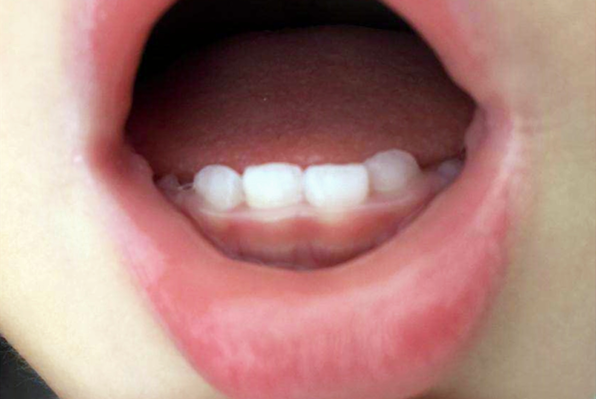 孩子补钙半年出现“猛涨期”，医生急忙喊停，补钙警惕发育假象