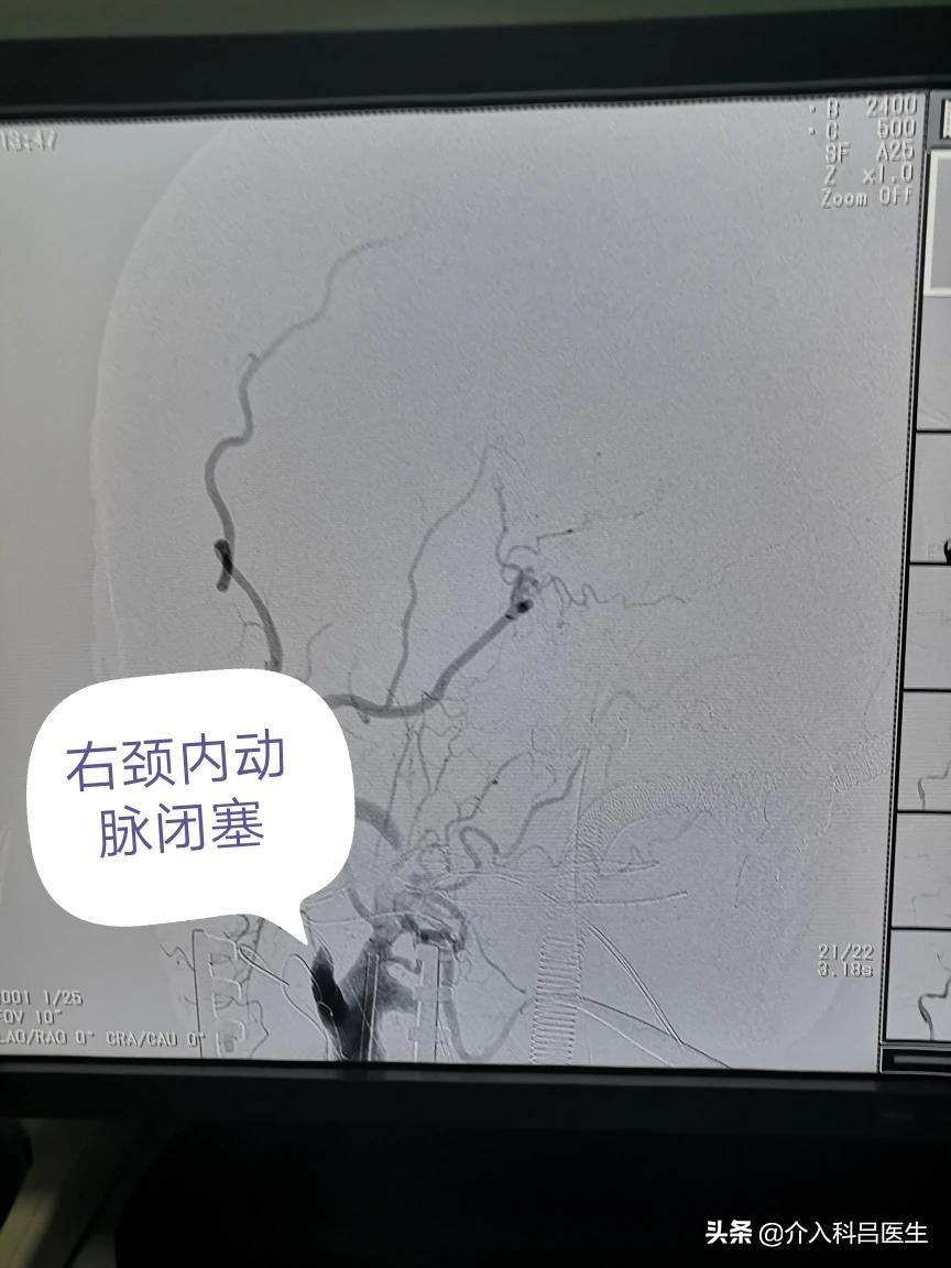 86岁左侧颈内动脉狭窄怎么办,75岁颈动脉狭窄81%咋样治疗