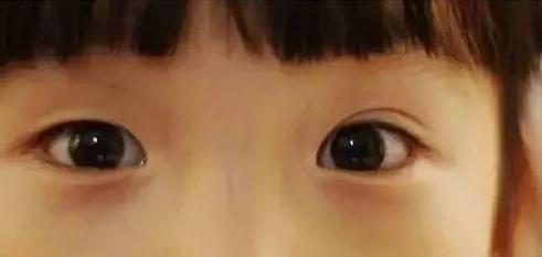 割双眼皮要怎样才知道合适自己,割过双眼皮和没割过双眼皮的区别