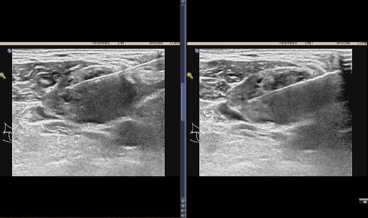 查出来“甲状腺癌”，还能活多久？最详细的治疗介绍如下