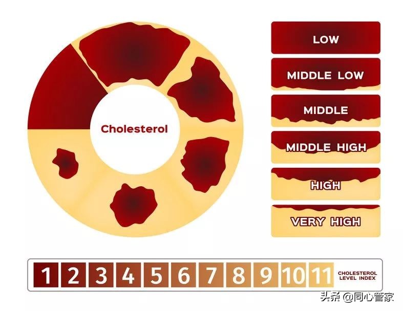 血管狭窄如何扼住生命的咽喉?让你全身器官都遭殃