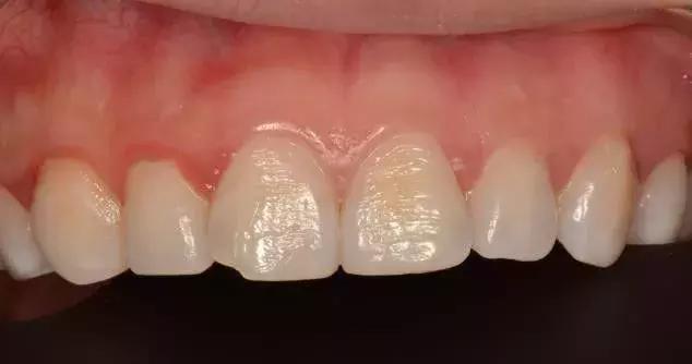 牙齿烂了一半为什么不能补牙,牙齿缺了一半补牙要多少钱