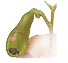 胆囊息肉会癌变吗?听医生的,医生说了算