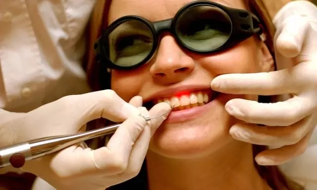 以前是怎么拔牙的,以前拔牙怎么拔的