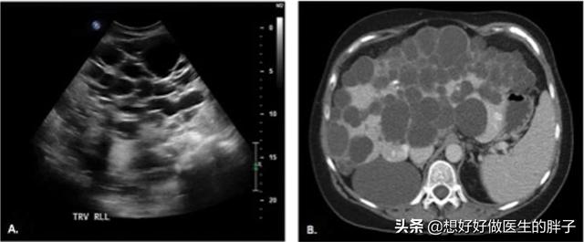 辟谣囊肿手术,得了囊肿必须切除么