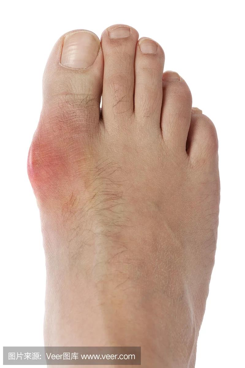 尿酸高一开始会不会脚底痛,尿酸高会一个脚趾痛