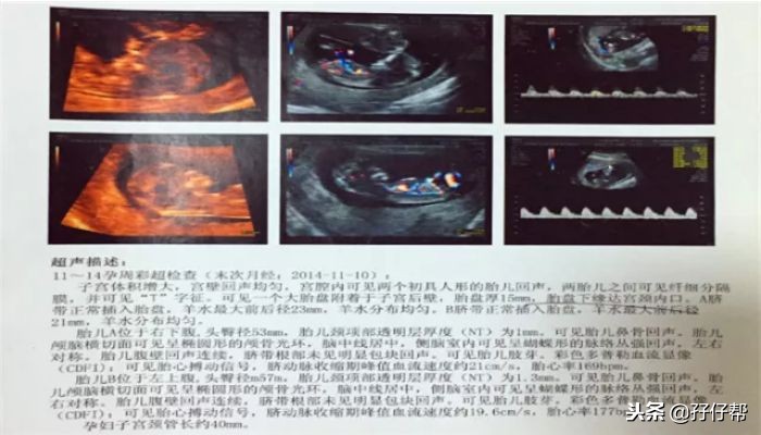 12周双胎,孕12周孕妈妈会有什么感觉