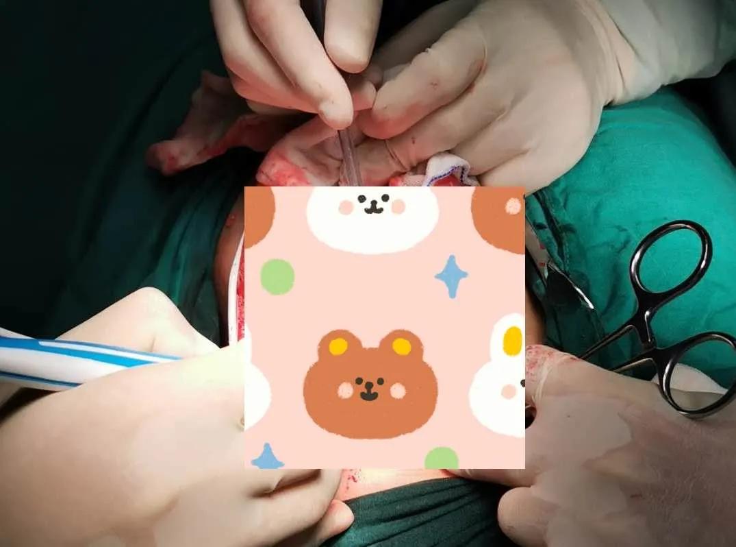 一女孩臀部长了大肿瘤，我院多科室协作切除肿瘤