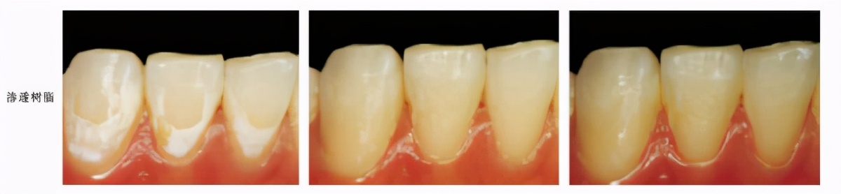牙齿脱矿了如何补救,牙齿脱矿了怎么治