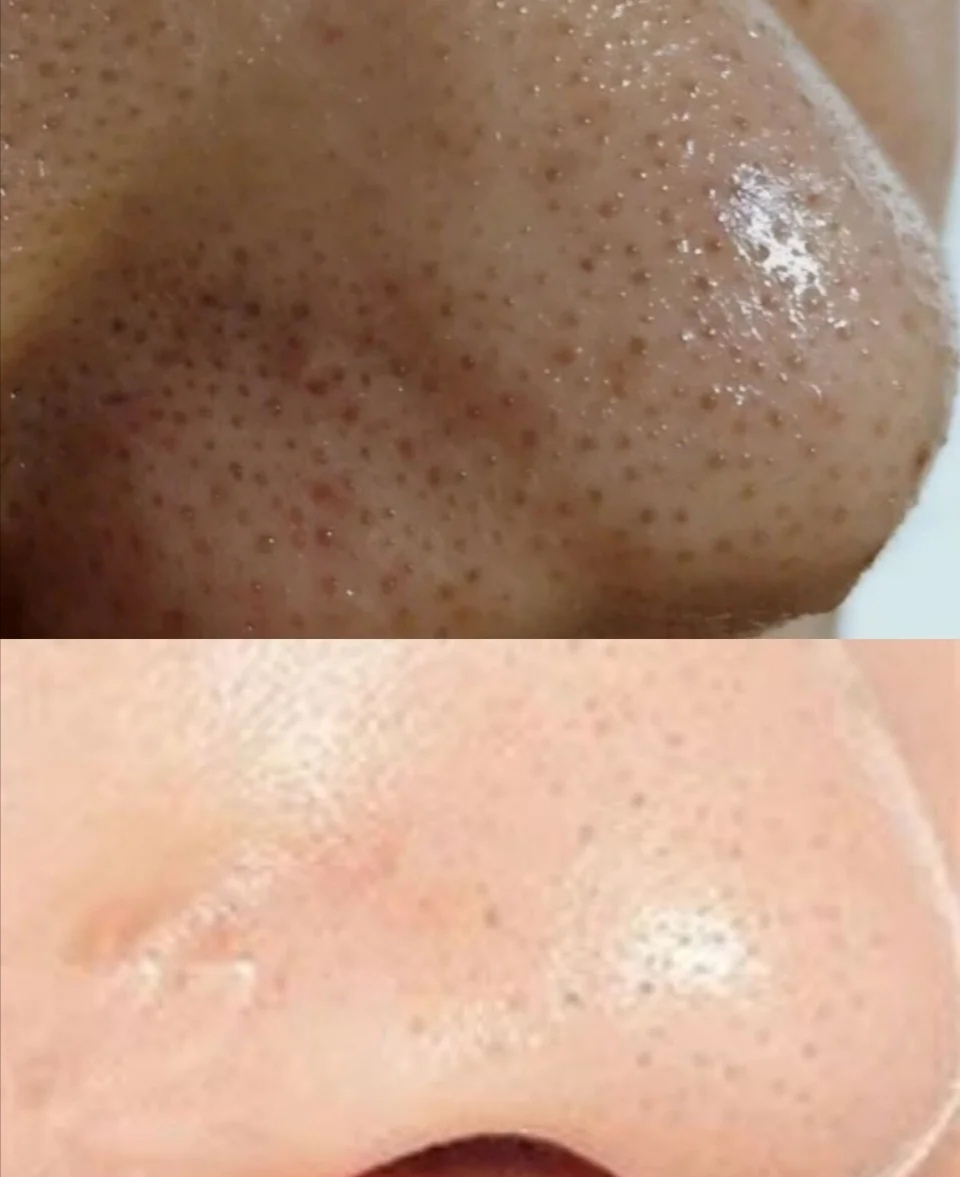 去黑头不伤皮肤的最好方法,去黑头不伤皮肤的最有效方法