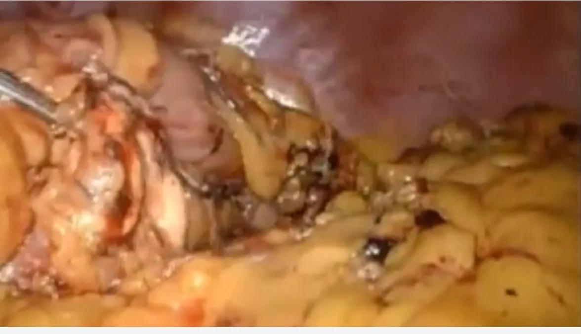 腹腔镜胰体尾切除术打孔位置,胰体尾肿瘤切除后复查哪些