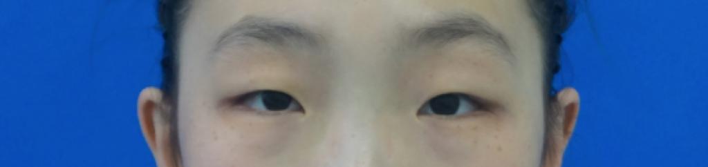 双眼皮手术详细教程,埋线双眼皮手术全过程