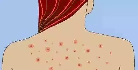 背上长痘痘有什么方法可以消除,背上长痘痘有什么简单的解决方法