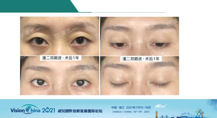 潘贰眼博士双眼皮原理,潘贰眼部整形案例
