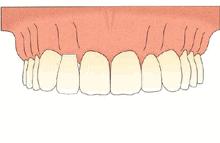 缺了一颗牙，是必须要做种植牙吗？有三种修复方式可选择