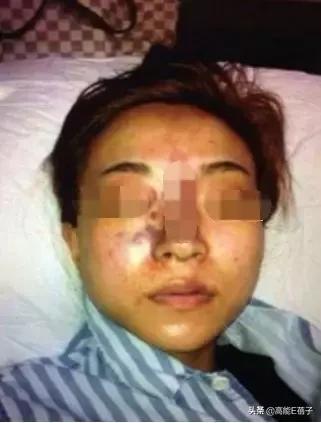 微整形需要多久,最受欢迎的5大微整形