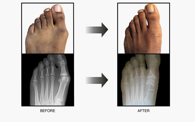 拇外翻大脚趾疼如何在家就能治,大脚拇指痛要警惕