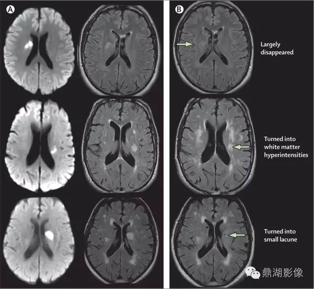 容易被误诊漏诊的脑小血管病,脑小血管病的基础知识