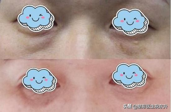 用鸡蛋去眼袋最快最好方法,滚鸡蛋去眼袋