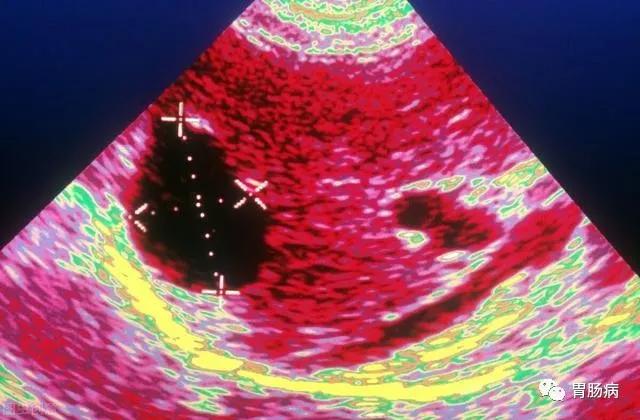 体检查出肝囊肿怎么办医生来教你,体检有肝囊肿怎么办