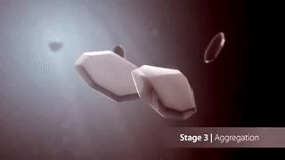 尿路结石知识,尿路结石影像