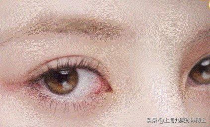 19岁全切双眼皮恢复图真实,眼修复手术