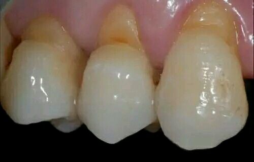 看完牙医牙齿酸软,牙齿酸软全身无力什么原因