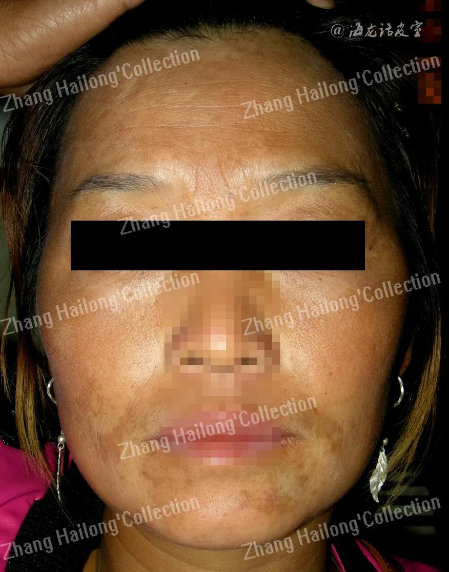 褐斑怎么办,褐斑能彻底去除吗