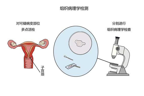 得了宫颈癌怎么活得久,宫颈癌离hpv有多远