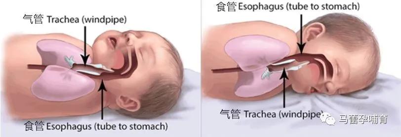 宝宝吐奶何时休？