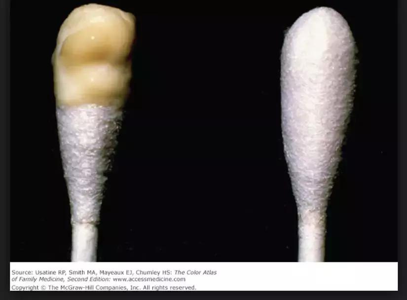 宫颈炎是普遍现象吗,宫颈炎真实报告