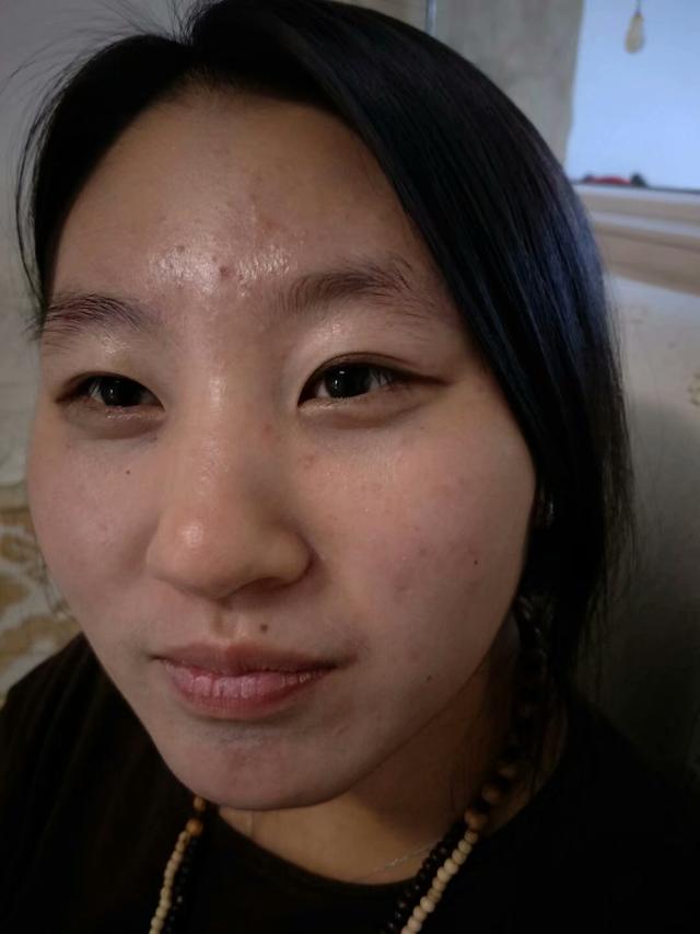 张家口祛痘印痘坑,张家口祛痘护理