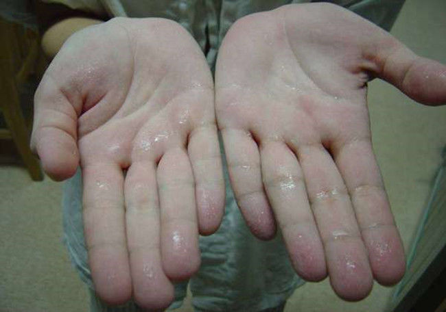 夏天手心汗多怎么办,夏天手心出汗有什么办法解决