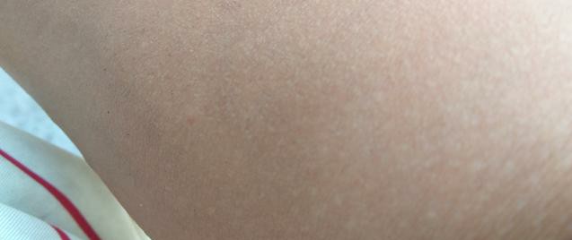 痘痘反复怎么除根护肤,痘痘反反复复怎么彻底祛除