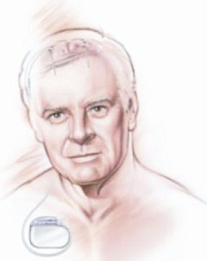 帕金森患者脑深部电刺激护理,帕金森脑深部电刺激手术步骤