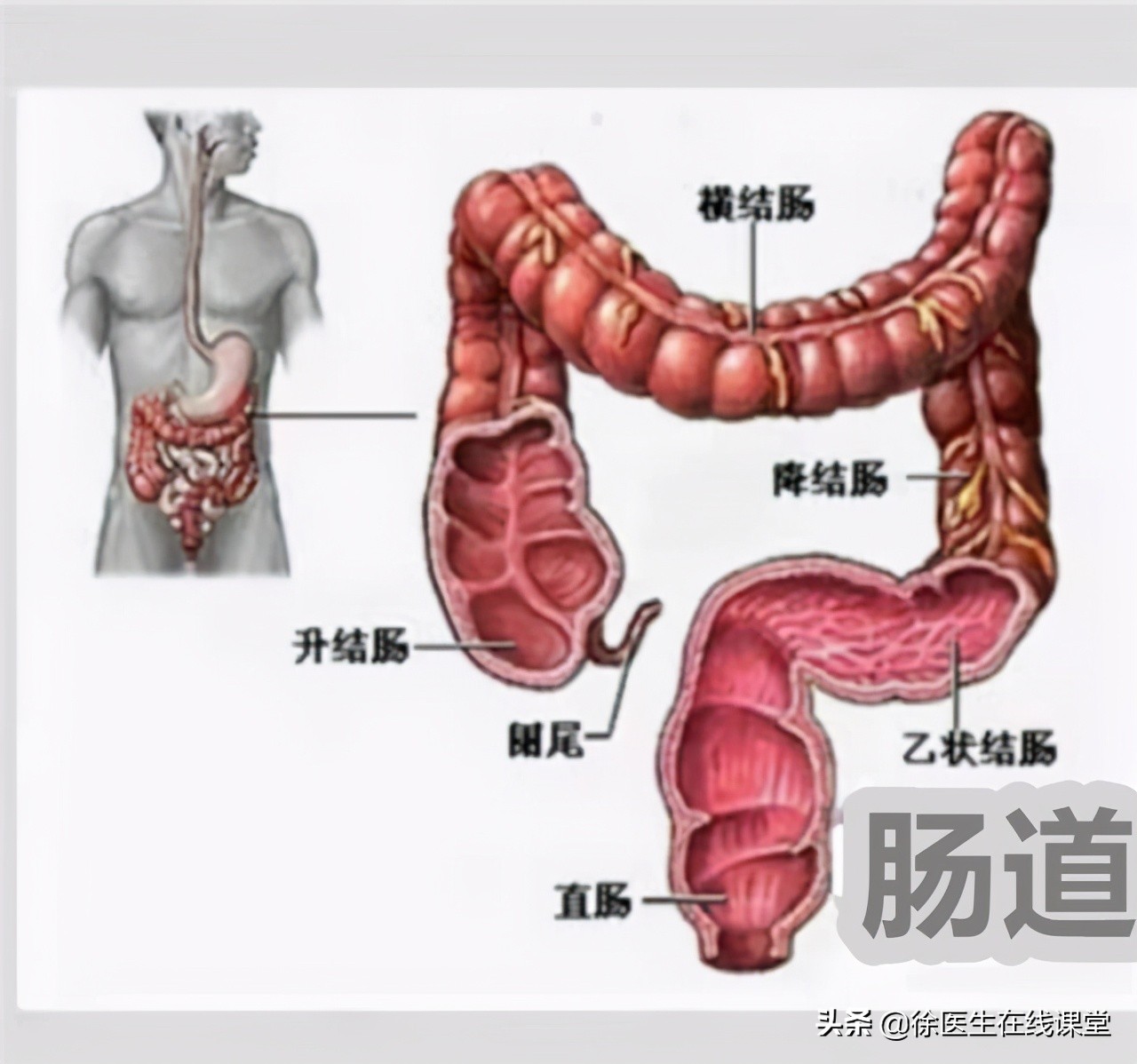 肠息肉到肠癌需要多久？肉眼咋判断是否已癌变？专家为你详细解答