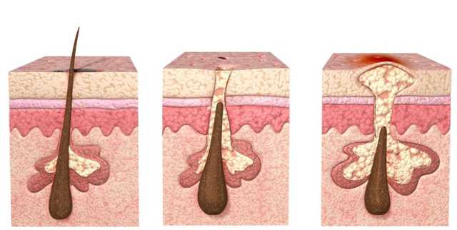 背部毛孔堵塞疏通小窍门,毛孔堵塞疏通小窍门
