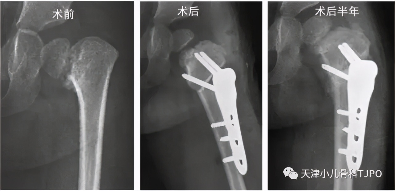 小儿先天性髋内翻名词解释,小孩走路颠足内翻