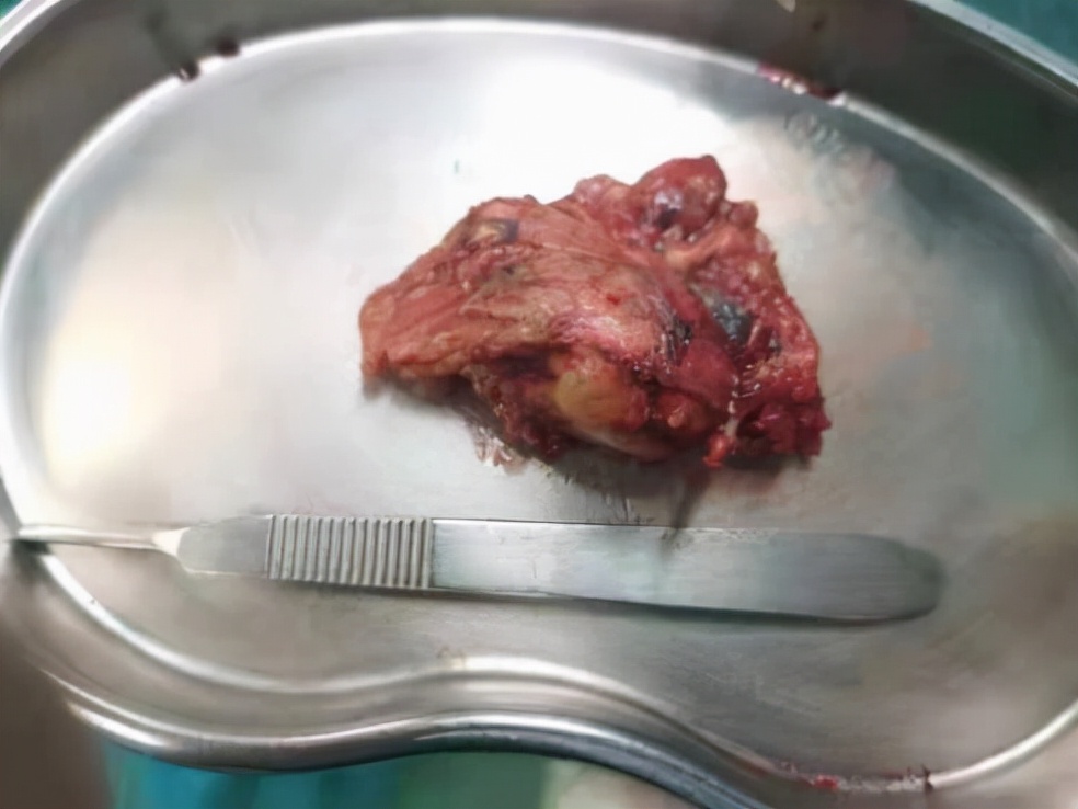 嗜铬细胞瘤泌尿外科,泌尿外科恶性肿瘤