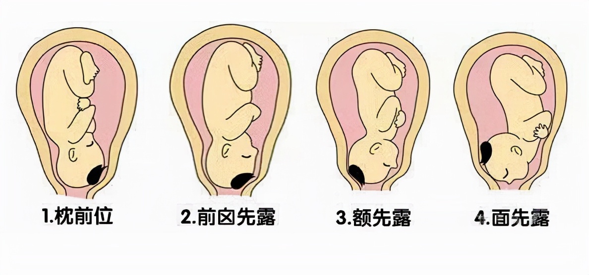 孕期胎位不正怎么办？别担心，除了纠正还有其他办法可以解决