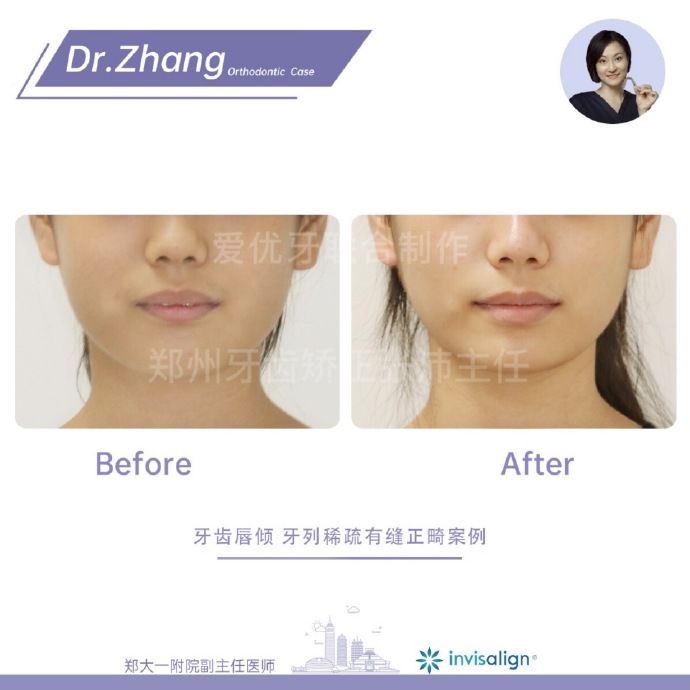 牙齿矫正郑州,郑州牙齿矫正案例合集
